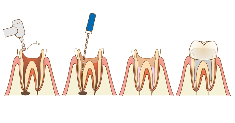 根管治療